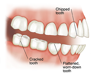 Side view of teeth and jaws showing cracked tooth, chipped tooth, and flattened, worn-down tooth.