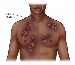 Front view of man's head and chest showing bullous pemphigoid.
