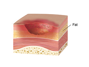 Cross section of skin, muscle. and bone showing stage three pressure injury, showing full thickness skin loss.