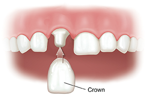 Closeup of teeth with one shaped tooth. Crown is being fitted on shaped tooth.
