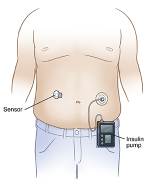 Front view of male torso with continuous glucose monitor sensor on abdomen, attached near one side of navel. Reciever attached to insulin delivery system on other side of navel. 