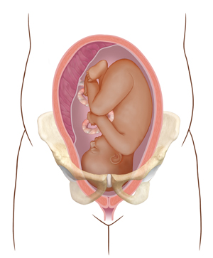 Front view cross section of uterus in pelvic bones showing fetus with head too large for birth canal.