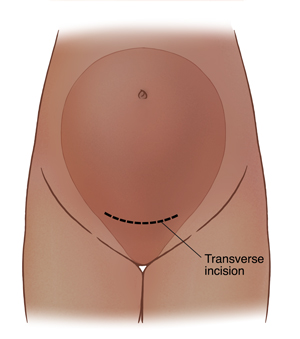 Outline of pregnant woman showing transverse incision in uterus.