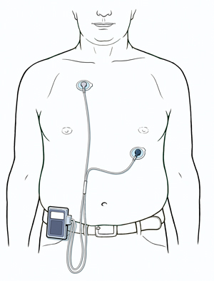 Man's torso showing two ECG leads attached to chest, connected to event monitor clipped to belt.