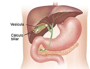 Contorno de un torso donde pueden verse el hígado y el estómago con un corte transversal de la vesícula con cálculos (piedras).